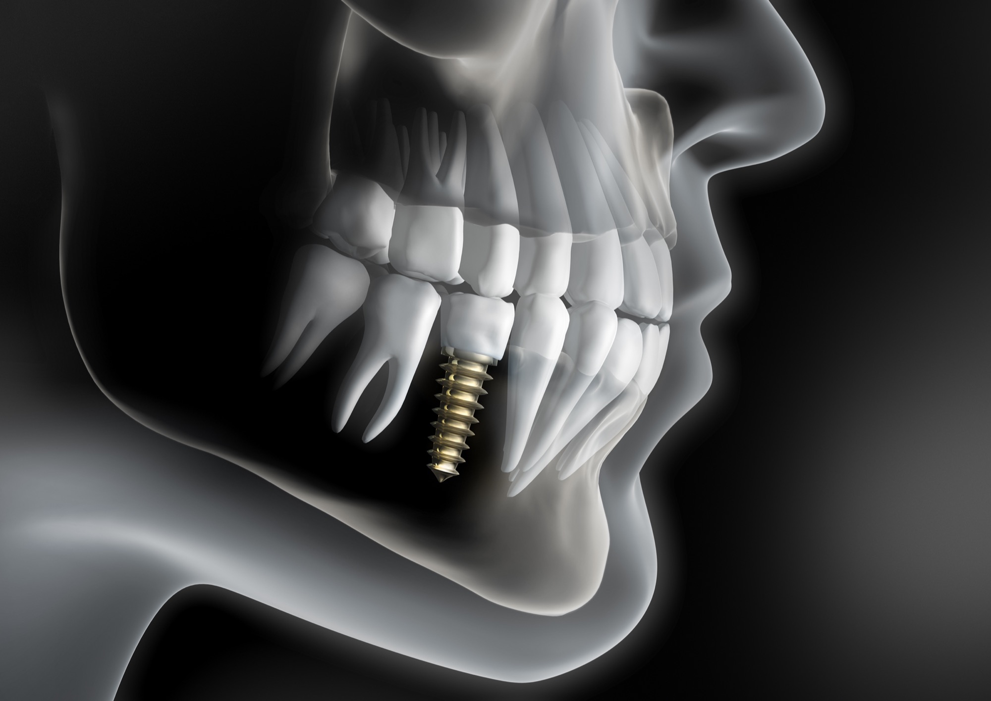 Individuelle Implantate